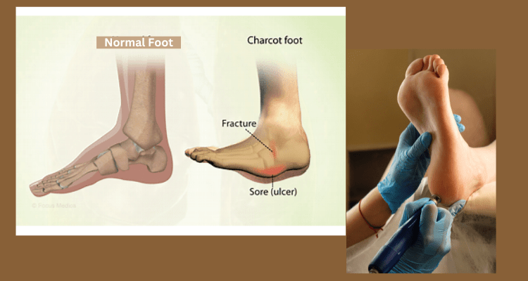 Foot Charcot Normal Foot